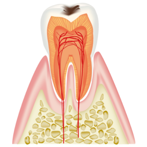 C1 Cavity within the Enamel