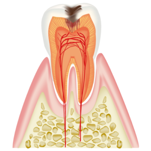 C2 Cavity Reaching the Dentin