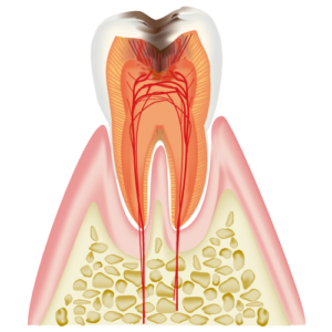 C3 Cavity Reaching the Dental Pulp (Nerve)