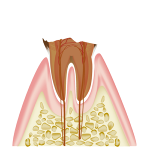 C4 Severely Decayed Tooth with Extensive Structure Loss