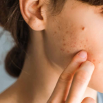 Acne Treatment