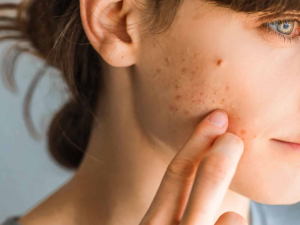 Acne Treatment