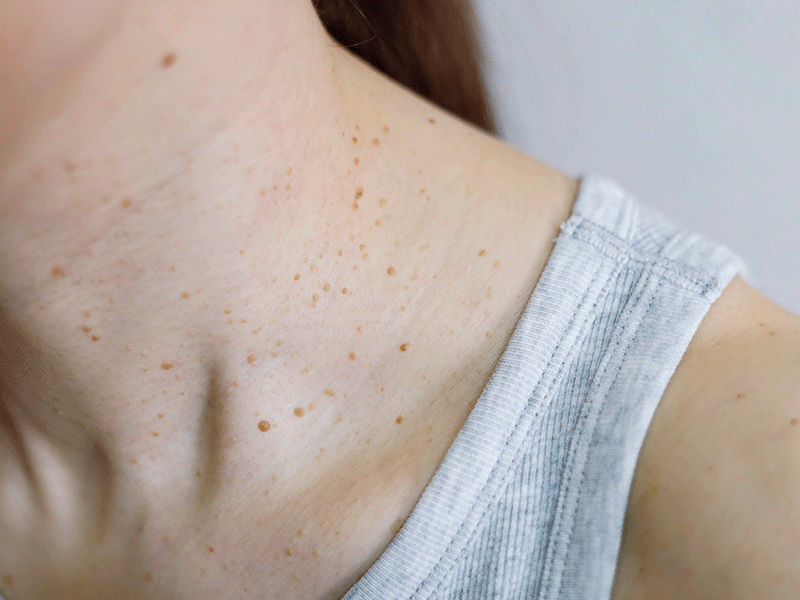 Warts & Skin Tags